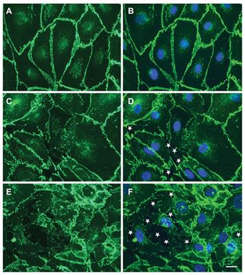 Circulating Extracellular Vesicles and Endothelial Damage in Sickle Cell Disease